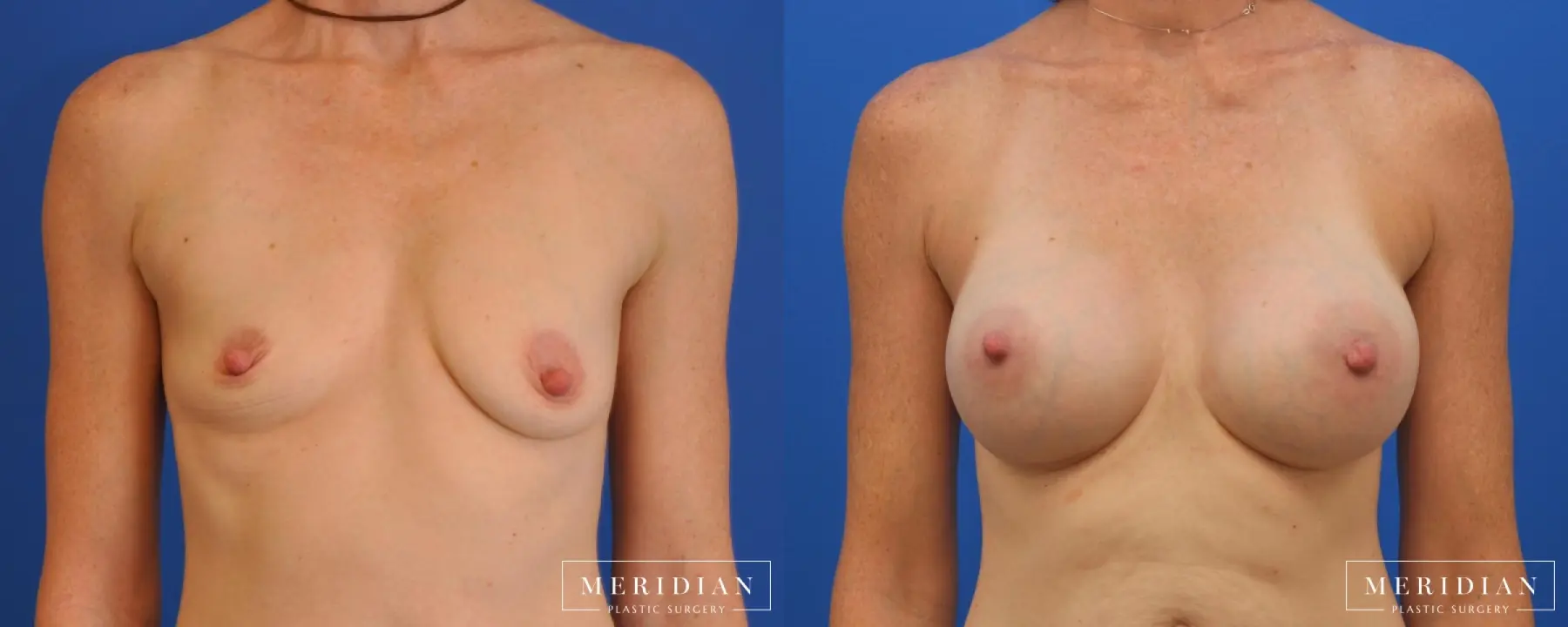 Breast Augmentation: Patient 16 - Before and After  