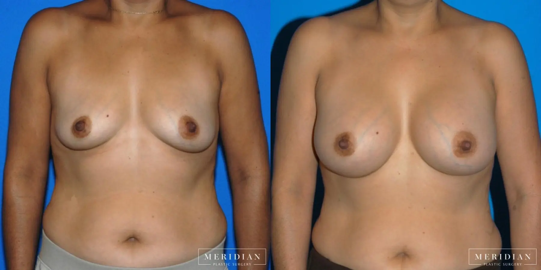 Breast Augmentation: Patient 27 - Before and After  