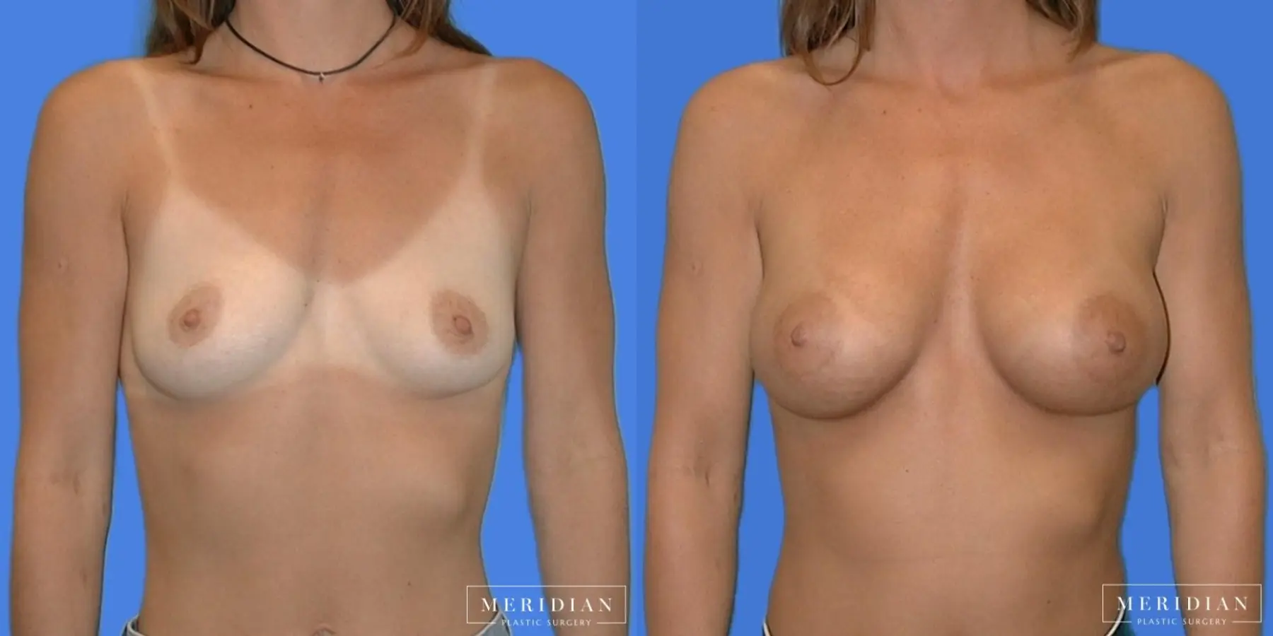 Breast Augmentation: Patient 15 - Before and After  