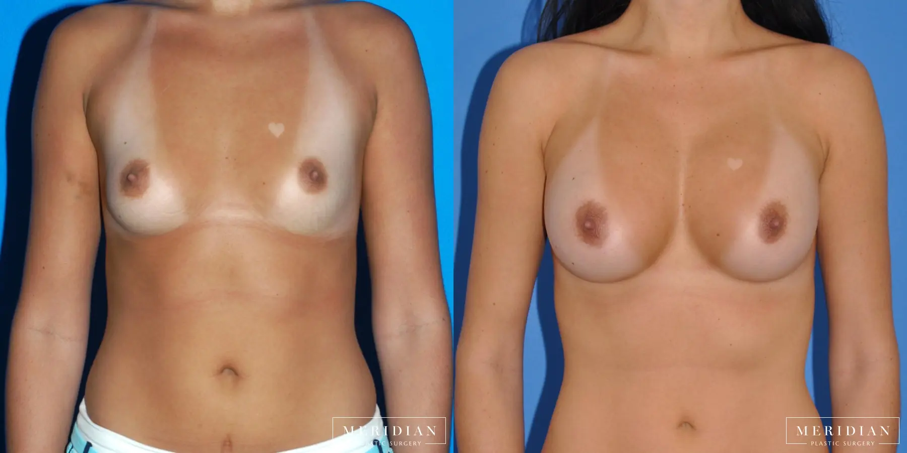Breast Augmentation: Patient 24 - Before and After  