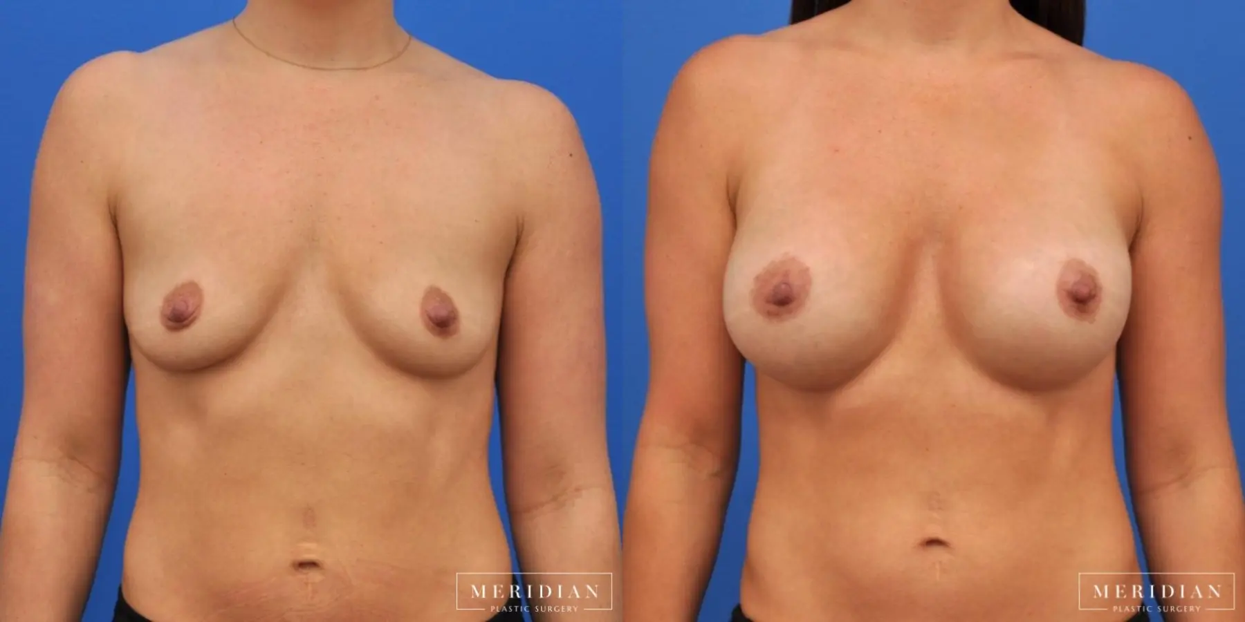 Breast Augmentation: Patient 51 - Before and After  