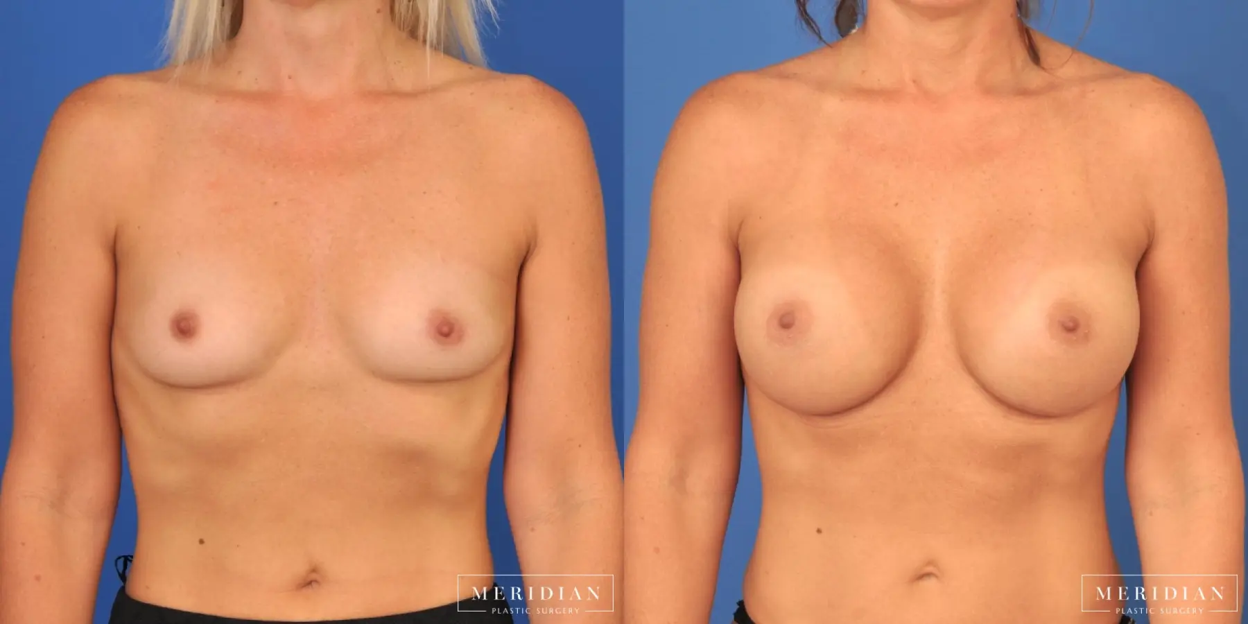 Breast Augmentation: Patient 23 - Before and After  