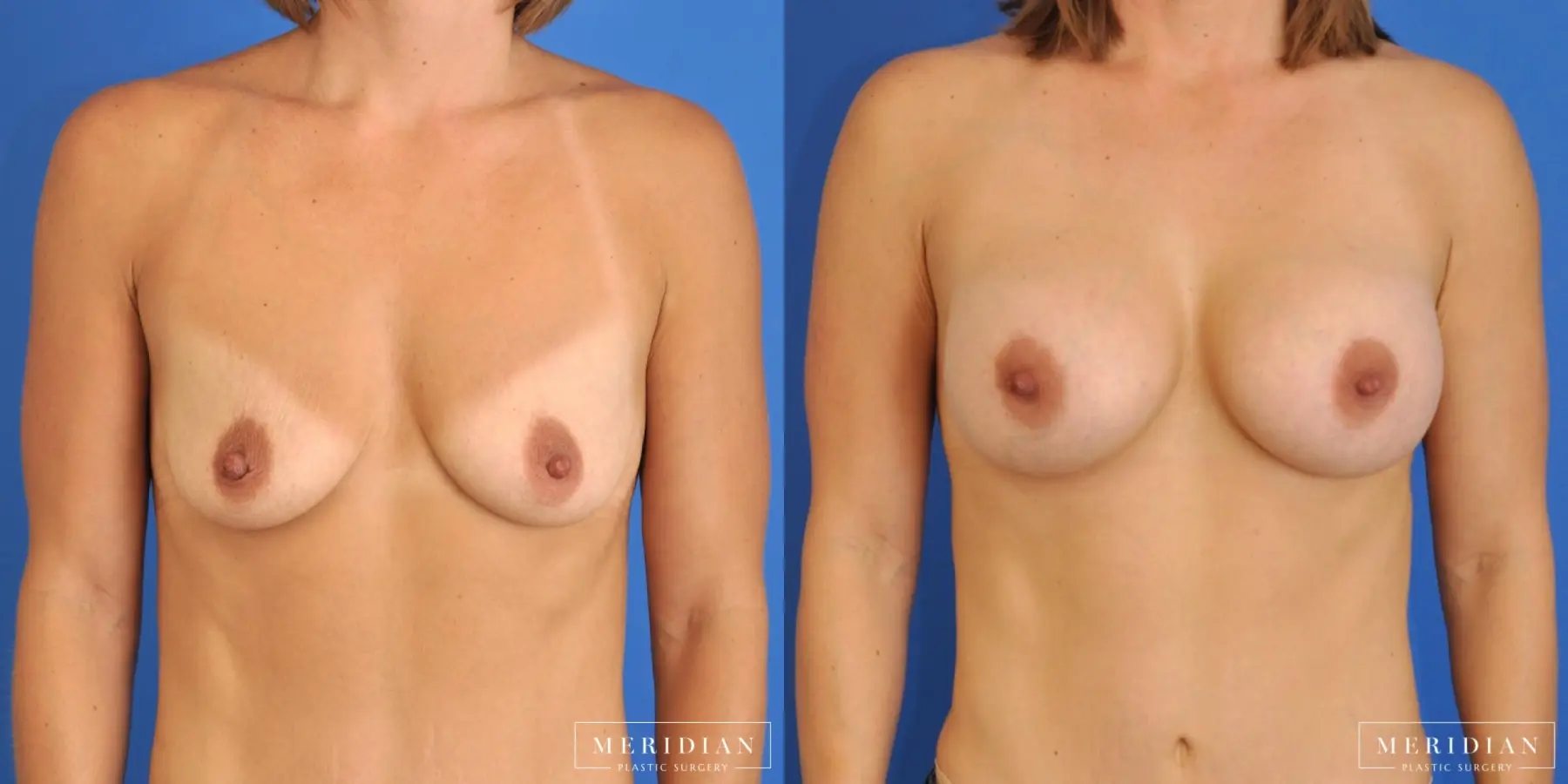 Breast Augmentation: Patient 28 - Before and After  