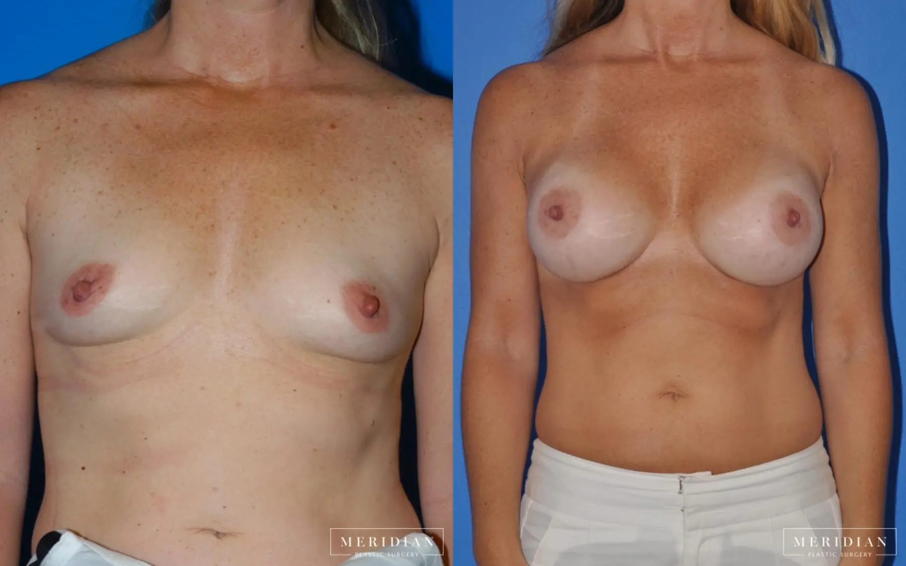 Breast Augmentation: Patient 52 - Before and After  