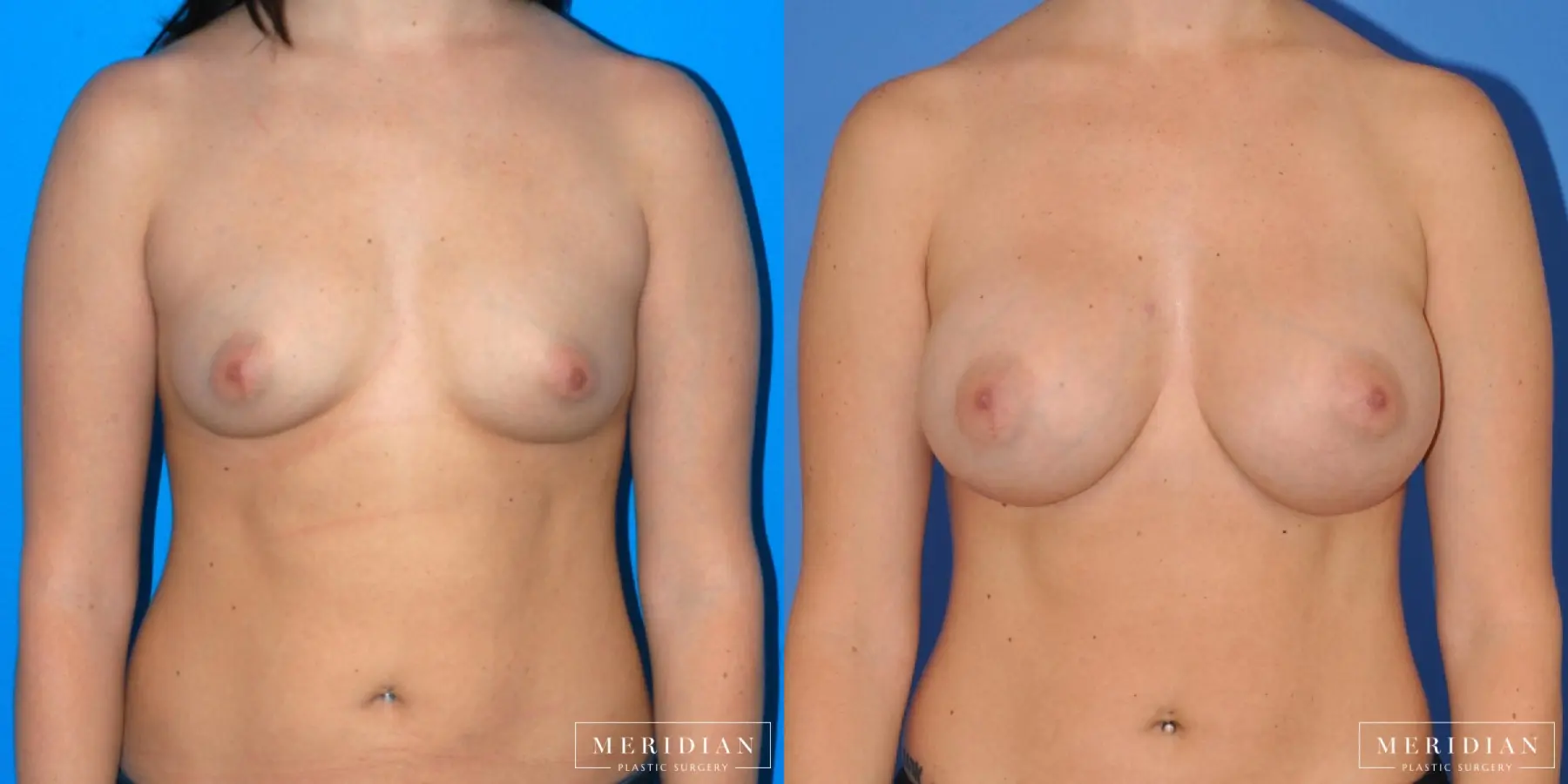 Breast Augmentation: Patient 12 - Before and After  