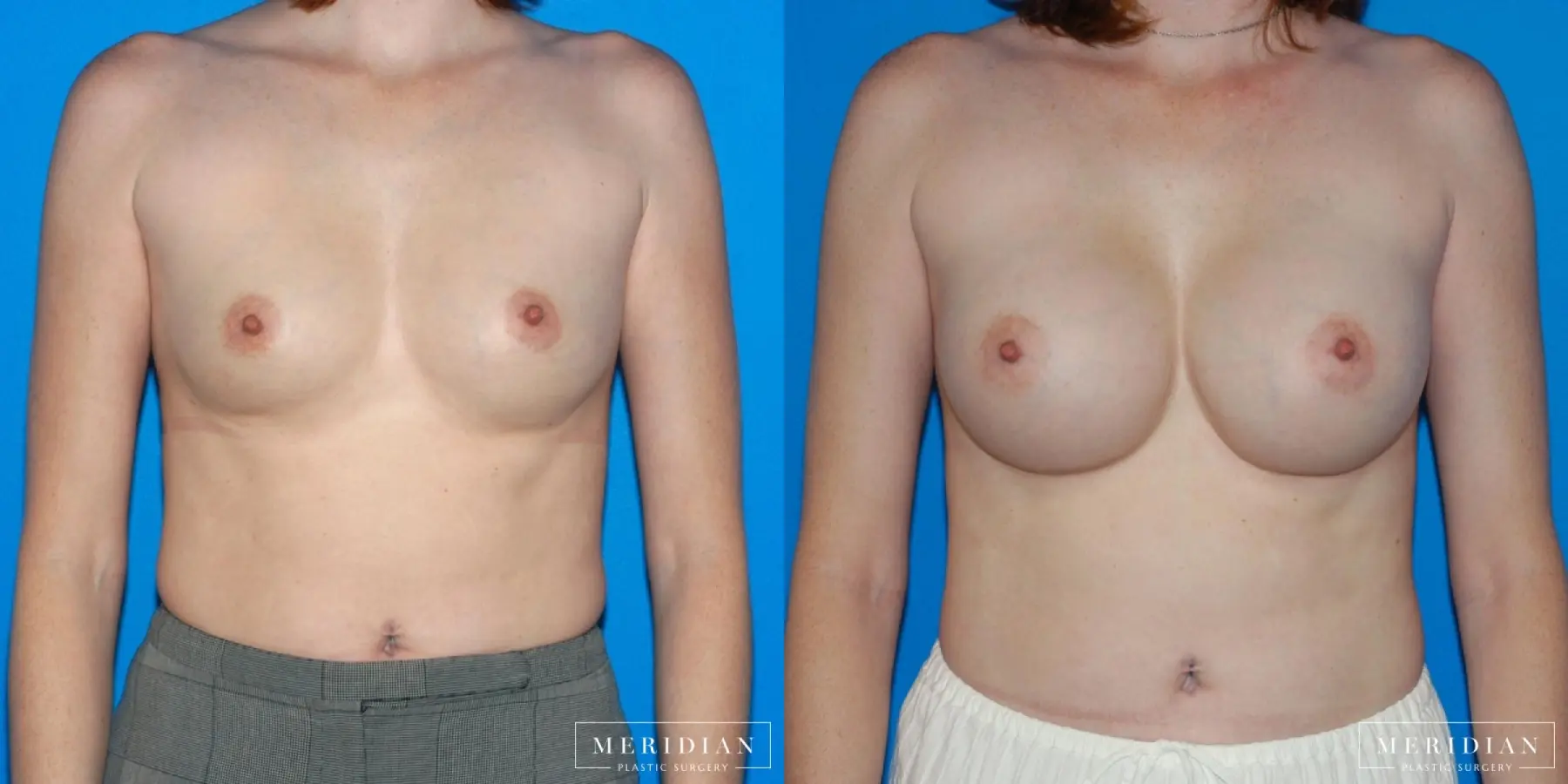 Breast Augmentation: Patient 29 - Before and After  