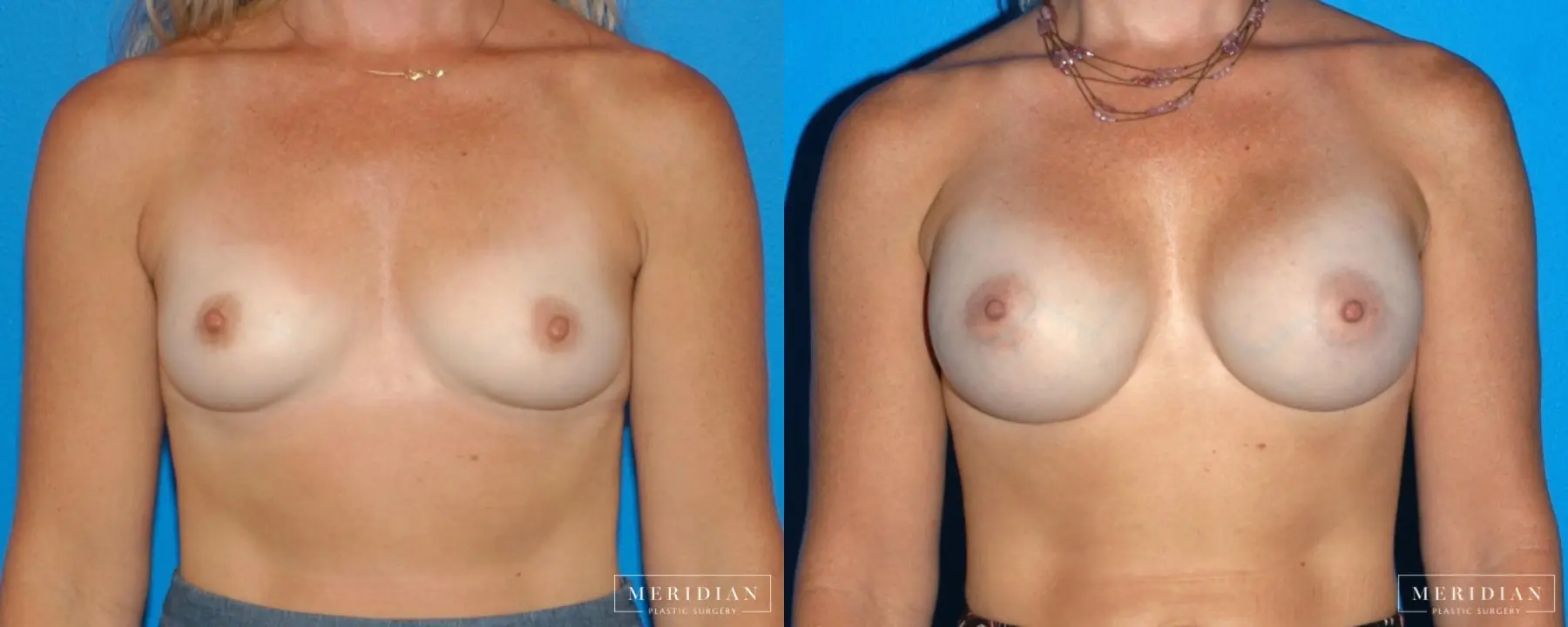Breast Augmentation: Patient 30 - Before and After  