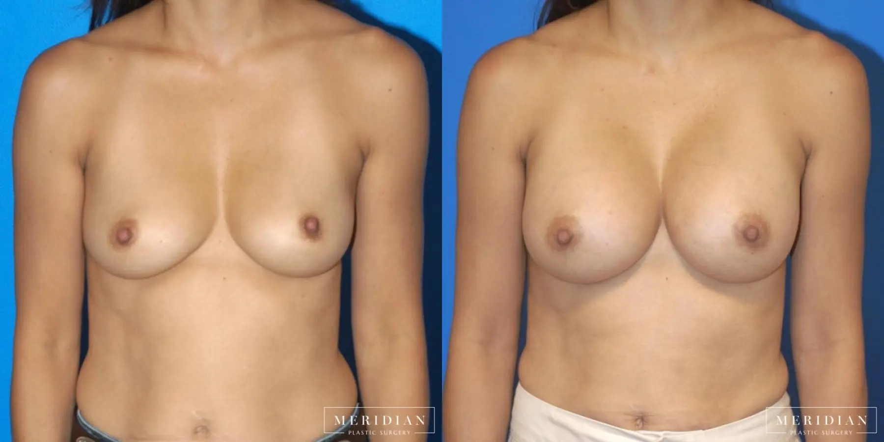 Breast Augmentation: Patient 19 - Before and After  