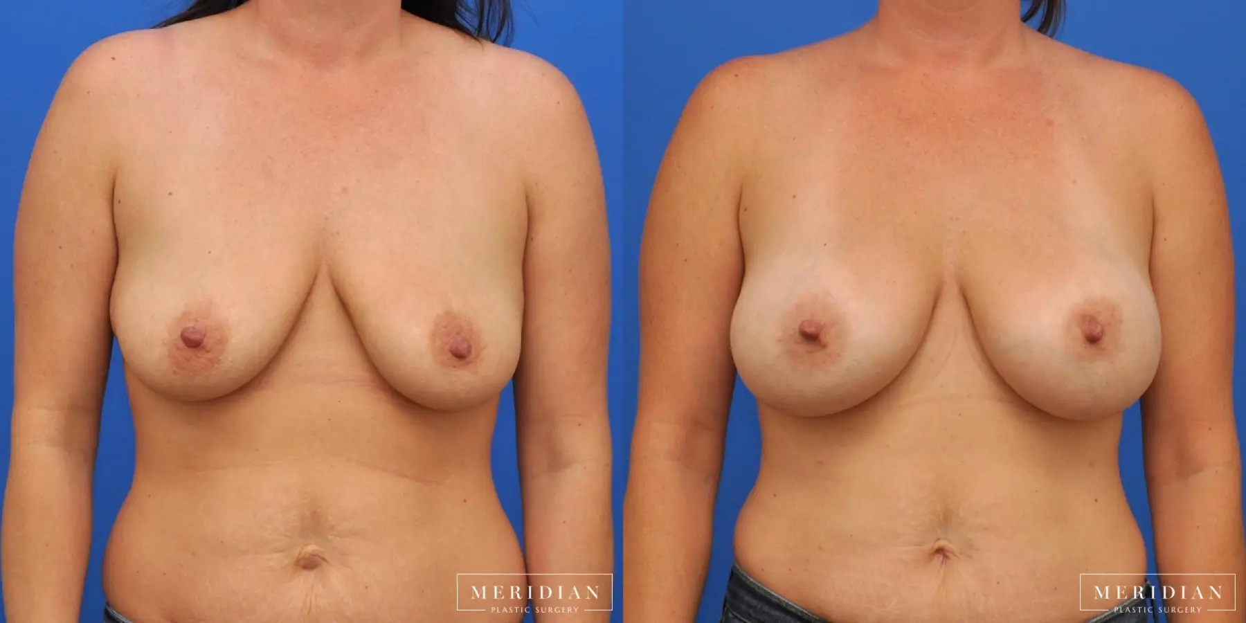 Breast Augmentation: Patient 20 - Before and After  