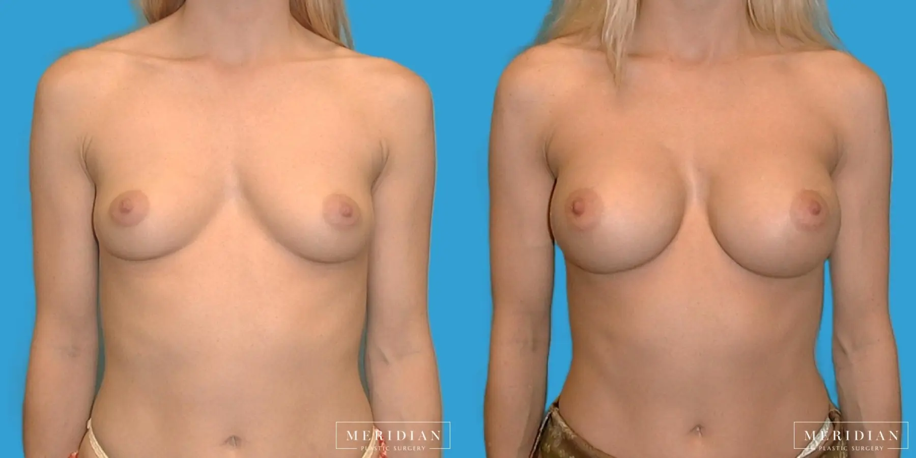 Breast Augmentation: Patient 13 - Before and After  