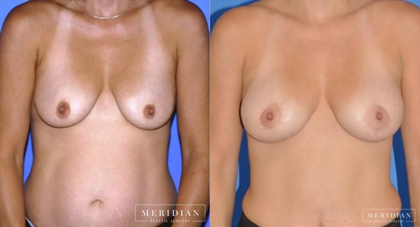 Breast Lift: Patient 5 - Before and After  