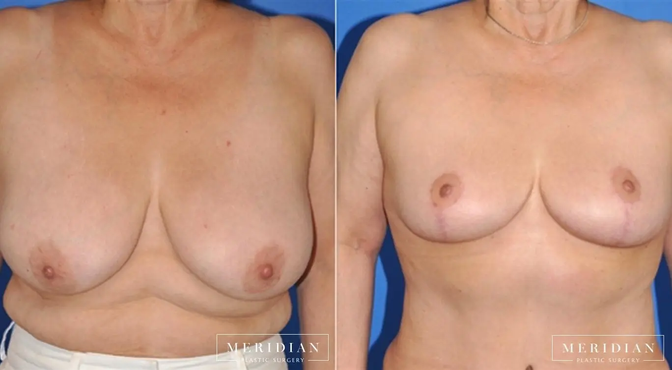 Breast Lift: Patient 14 - Before and After  