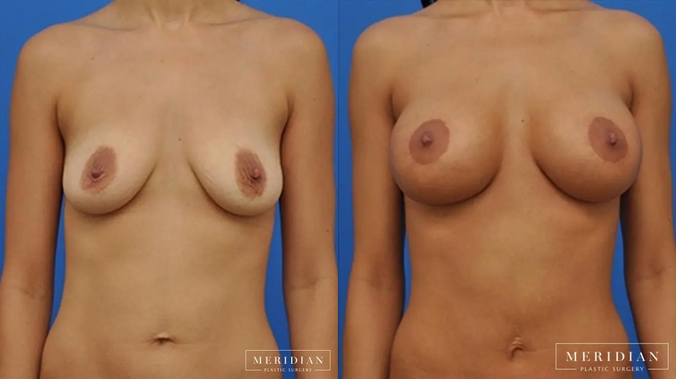 Breast Lift: Patient 2 - Before and After  