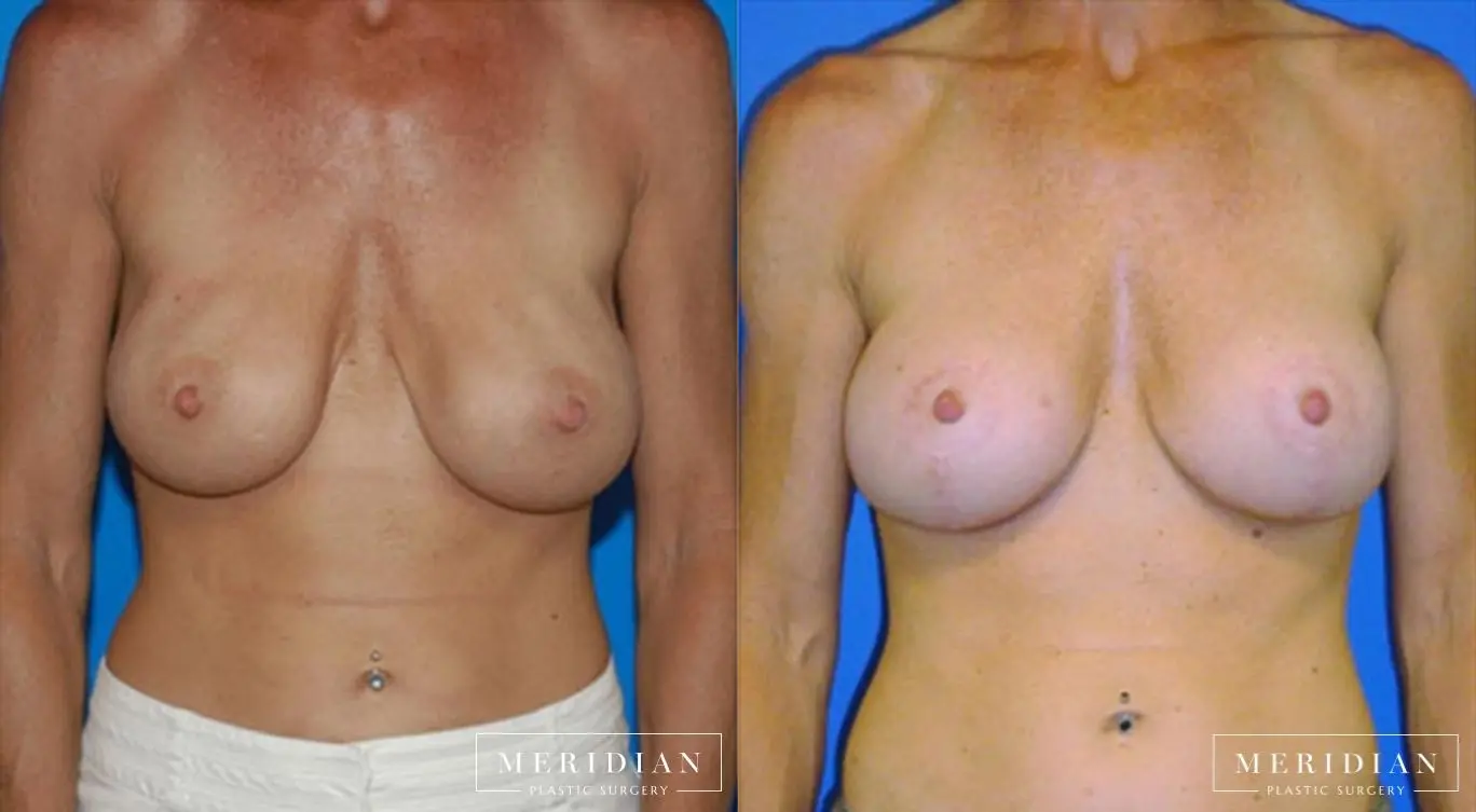 Breast Lift: Patient 13 - Before and After  
