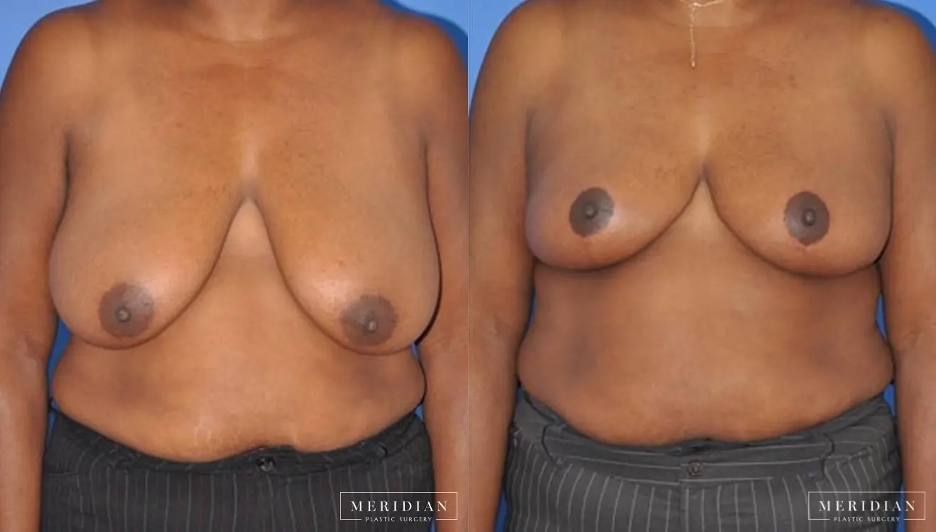 Breast Lift: Patient 4 - Before and After  