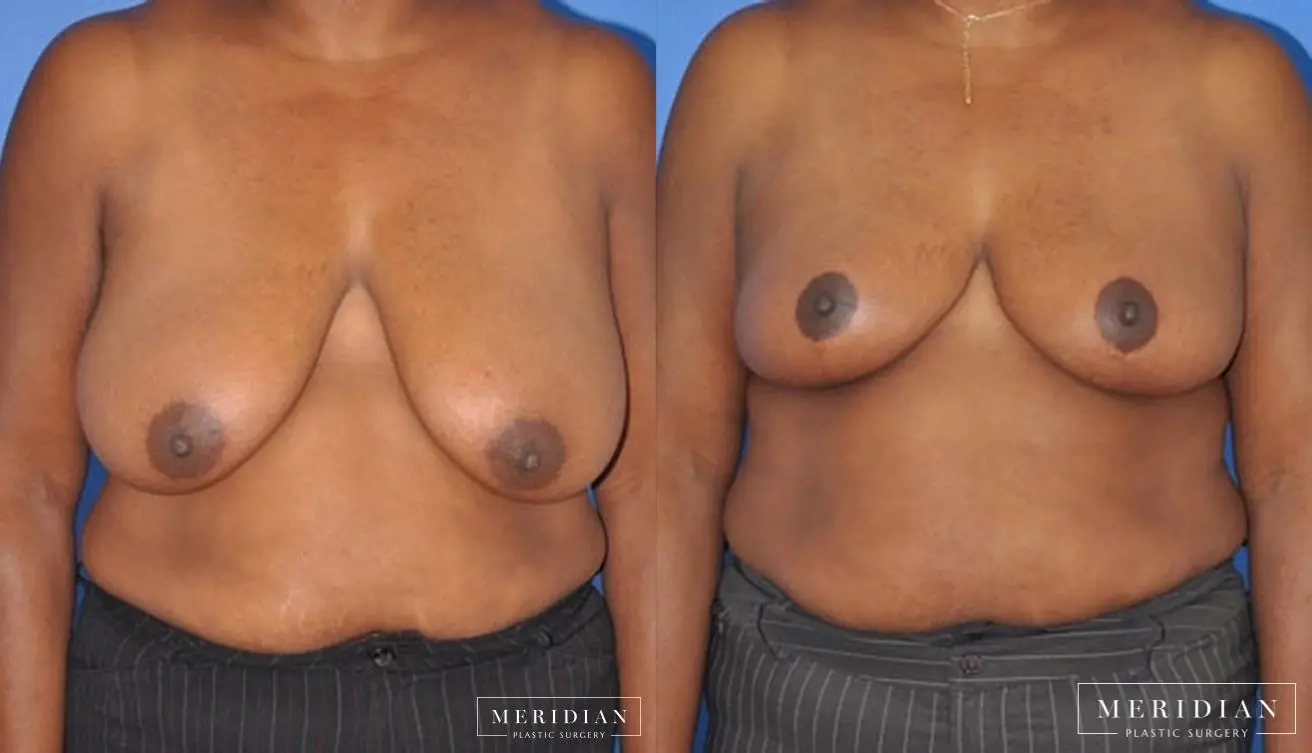 Breast Reduction: Patient 7 - Before and After  