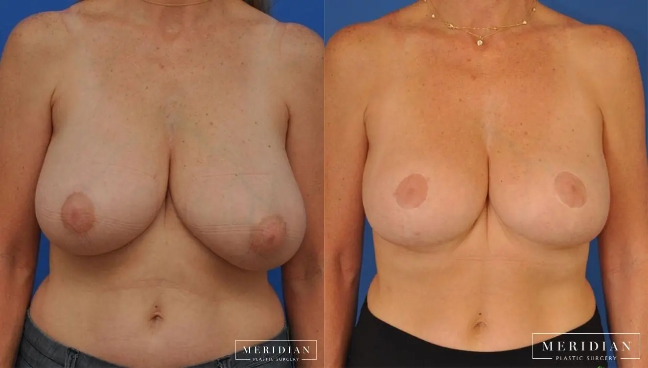 Breast Reduction: Patient 10 - Before and After  