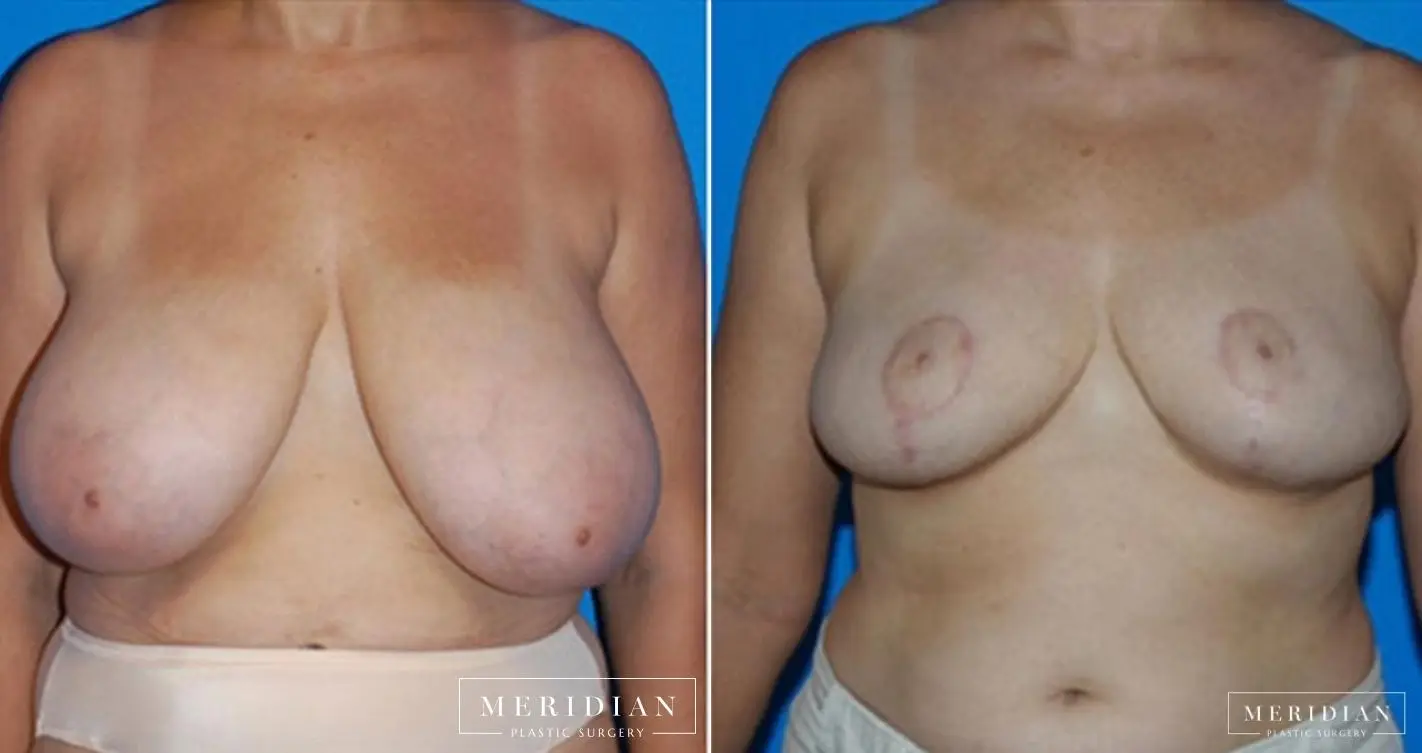 Breast Reduction: Patient 9 - Before and After  