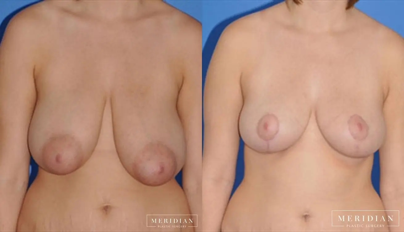 Breast Reduction: Patient 6 - Before and After  