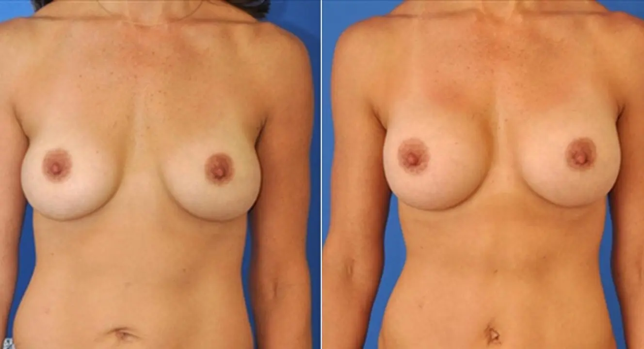 Breast Revision: Patient 8 - Before and After  