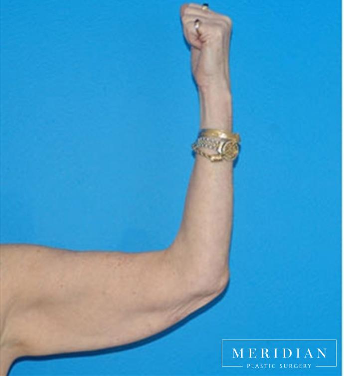 Body Contouring: Patient 14 - Before 