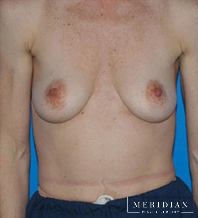 Breast Lift: Patient 11 - Before 