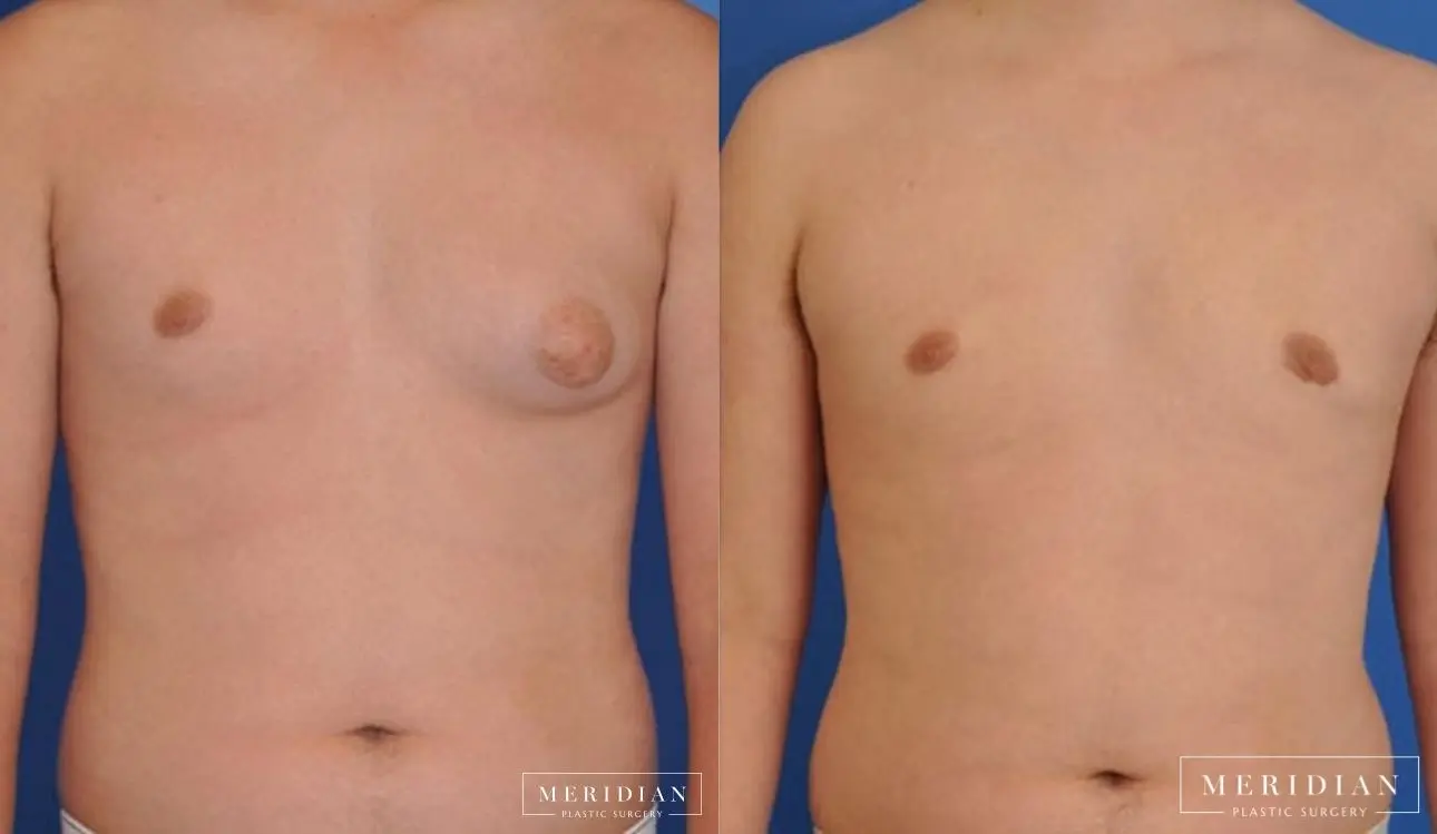 Gynecomastia: Patient 8 - Before and After  