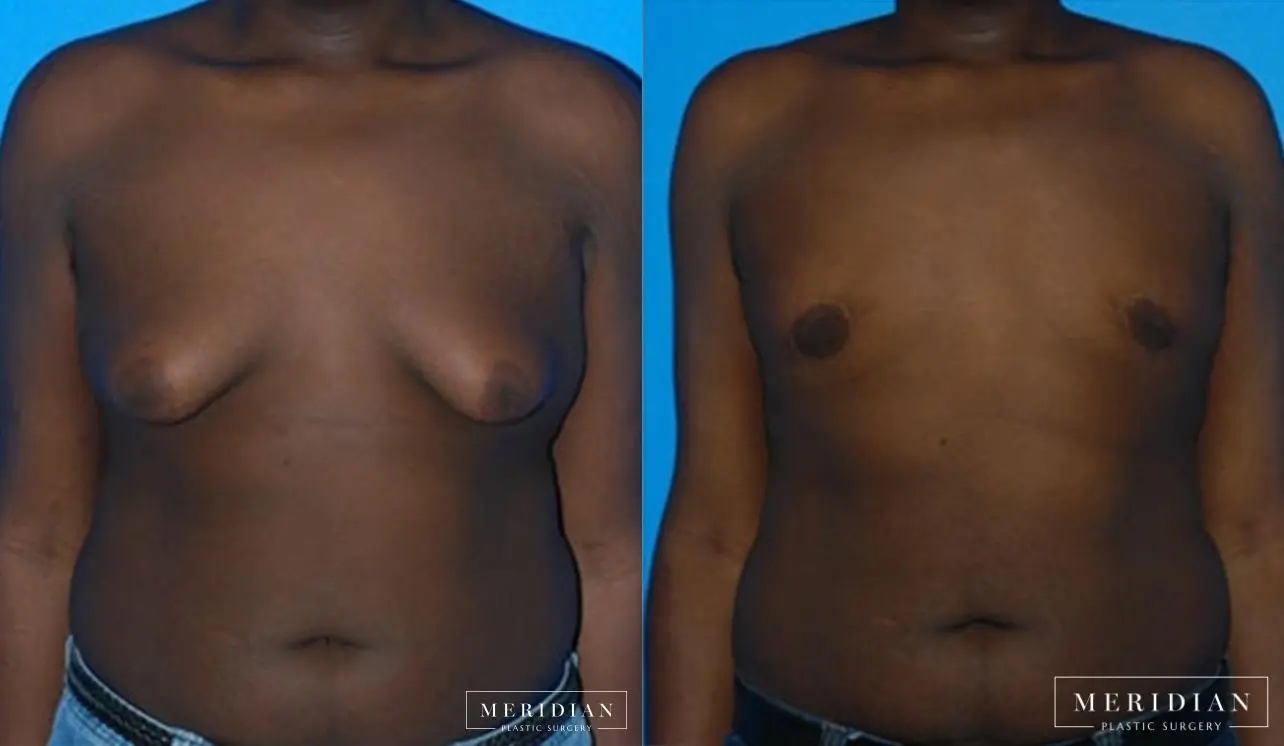 Gynecomastia: Patient 2 - Before and After  
