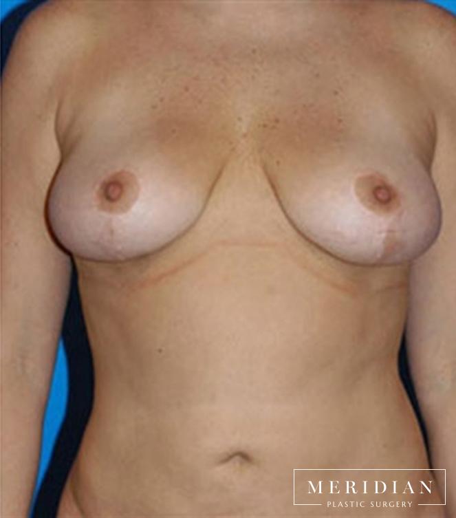 Body Contouring: Patient 19 - After 