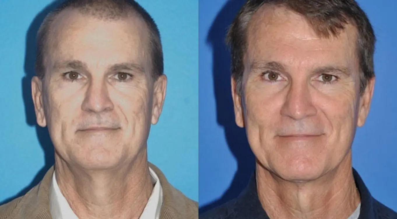 Neck Lift: Patient 4 - Before and After  