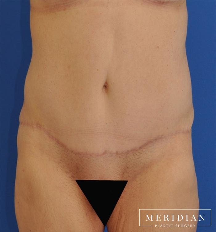 Tummy Tuck: Patient 17 - After 