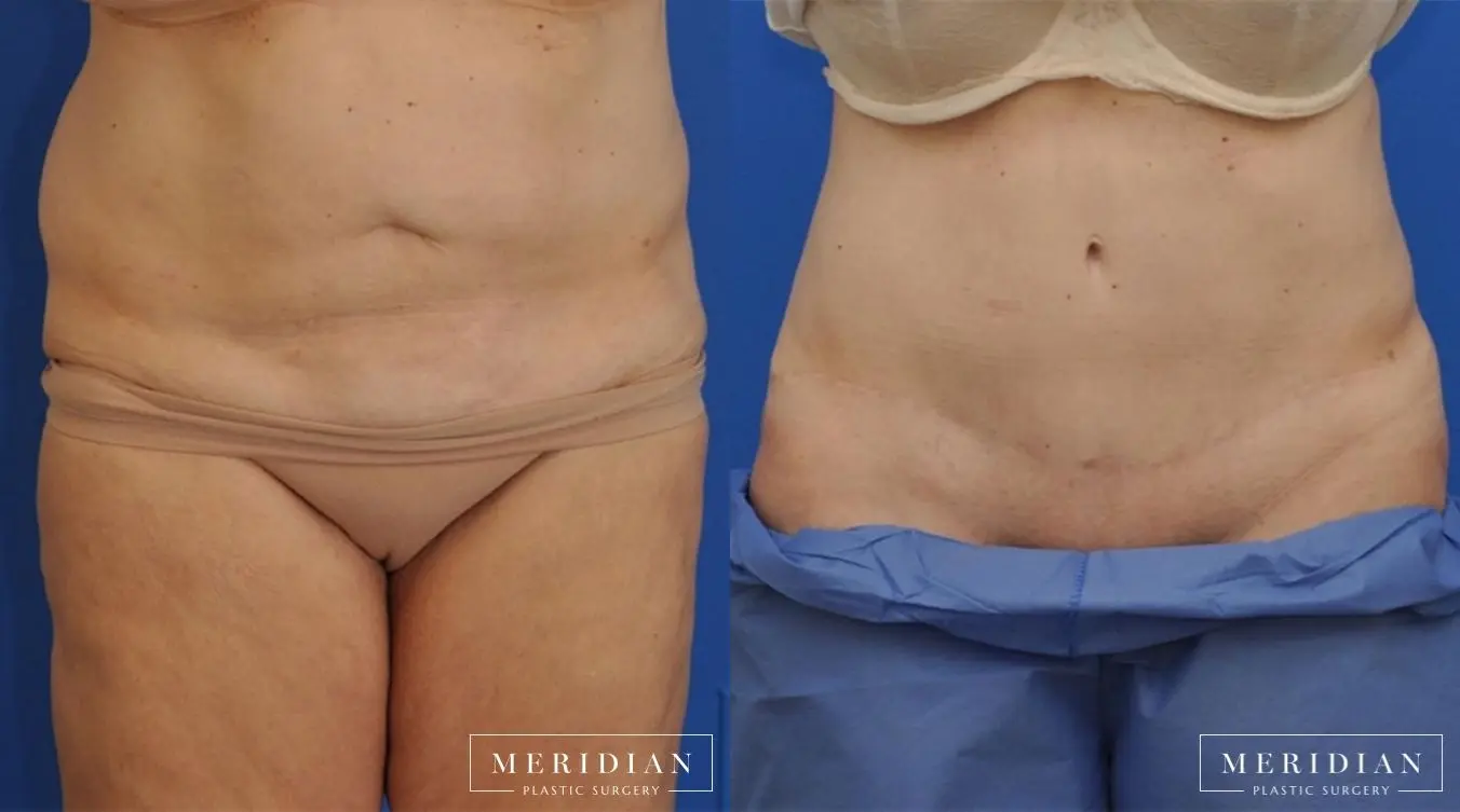Tummy Tuck: Patient 15 - Before and After  