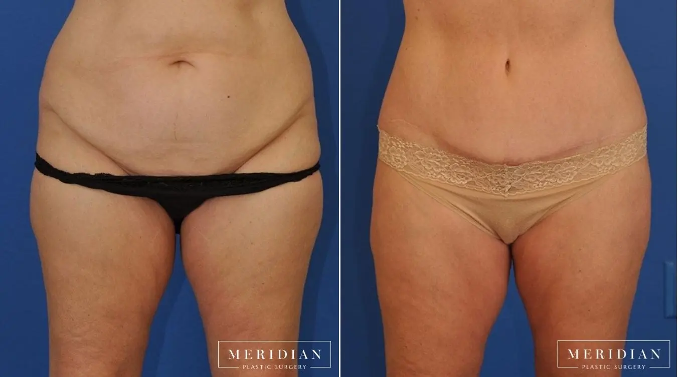 Tummy Tuck: Patient 19 - Before and After  