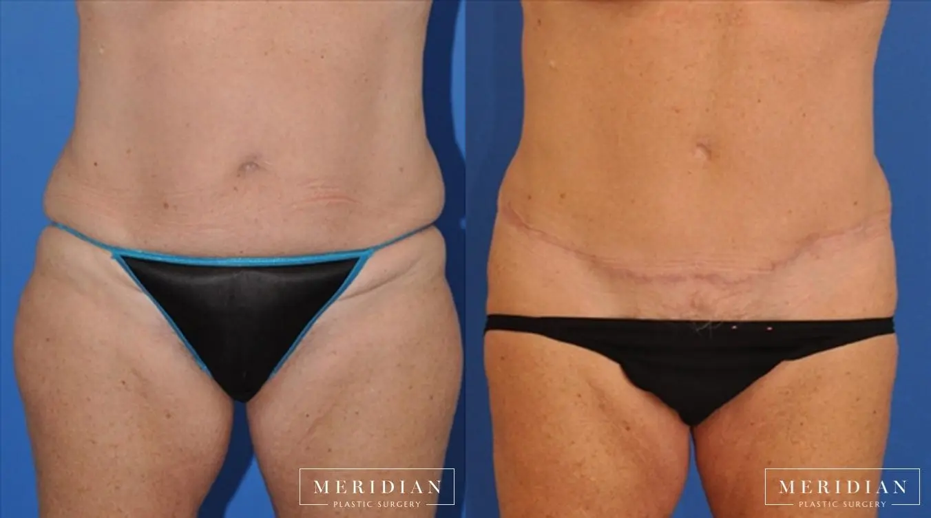 Tummy Tuck: Patient 13 - Before and After  