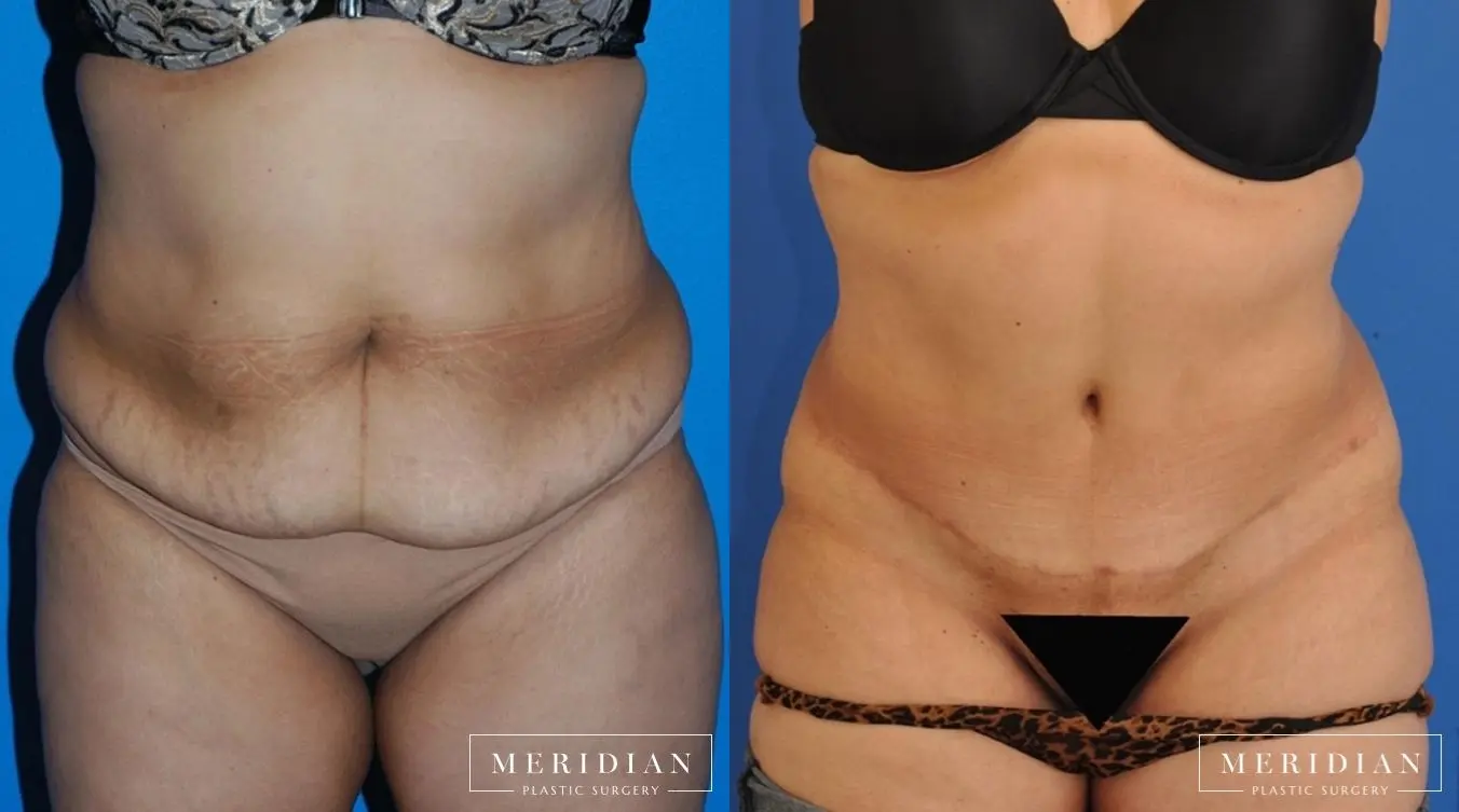 Tummy Tuck: Patient 14 - Before and After  