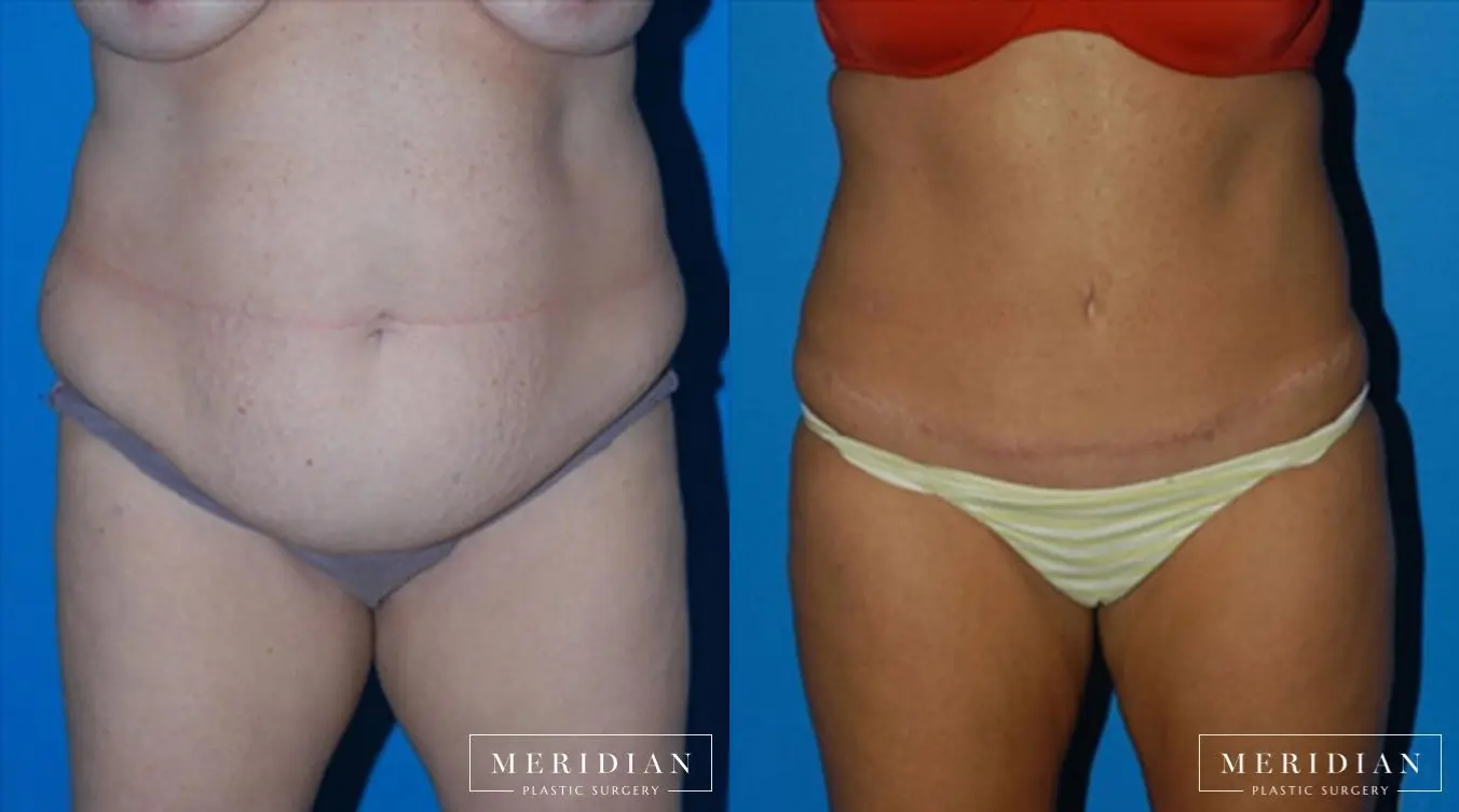 Tummy Tuck: Patient 11 - Before and After  