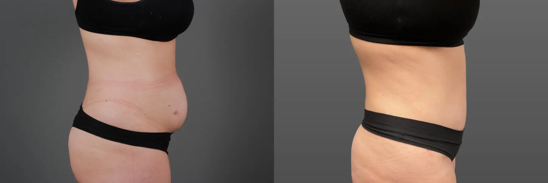 Abdominoplasty: Patient 11 - Before and After 2