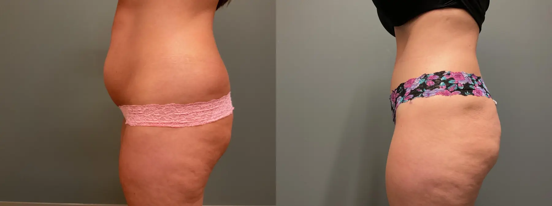 Abdominoplasty: Patient 13 - Before and After 4