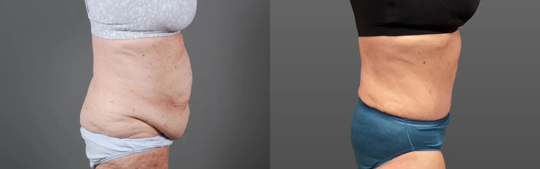 Abdominoplasty: Patient 12 - Before and After 2