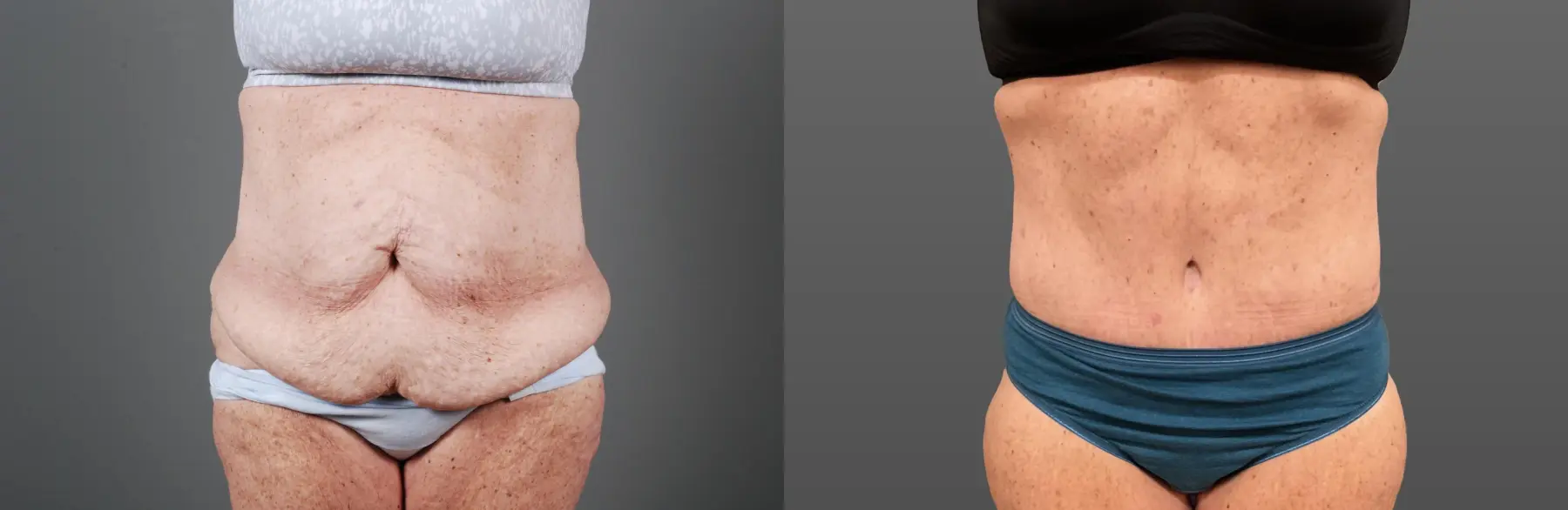 Abdominoplasty: Patient 12 - Before and After 1