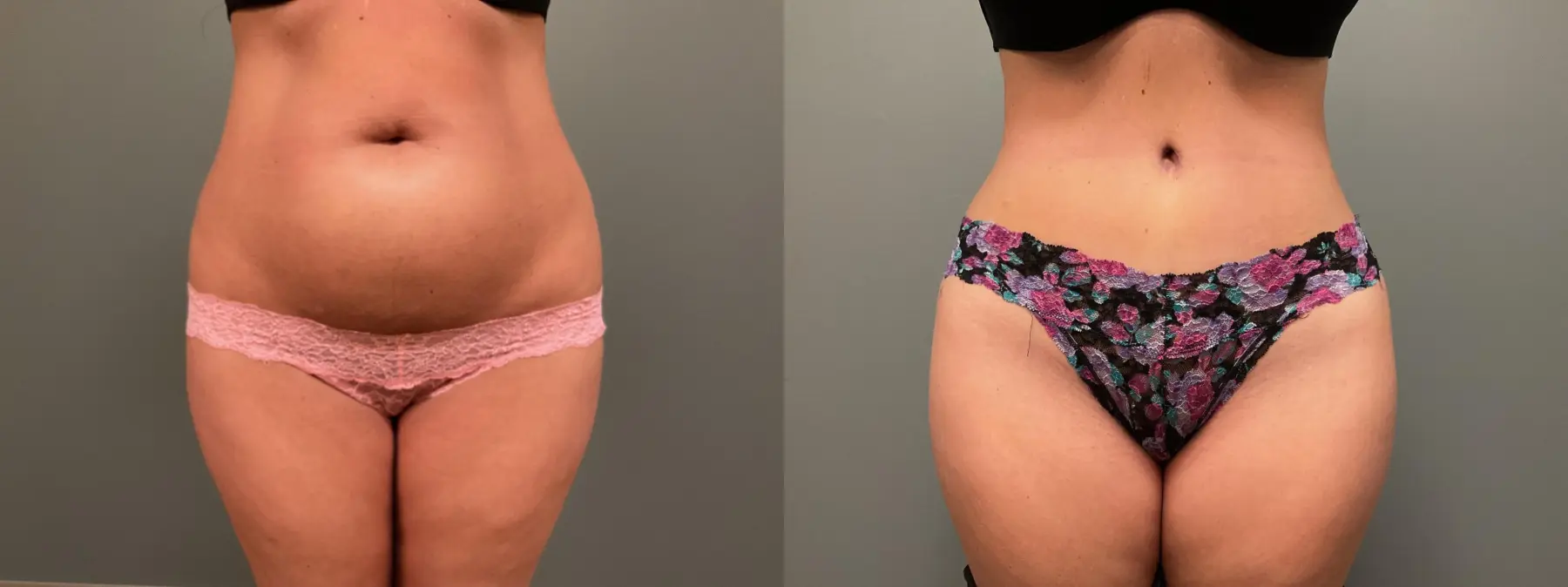 Abdominoplasty: Patient 13 - Before and After 1