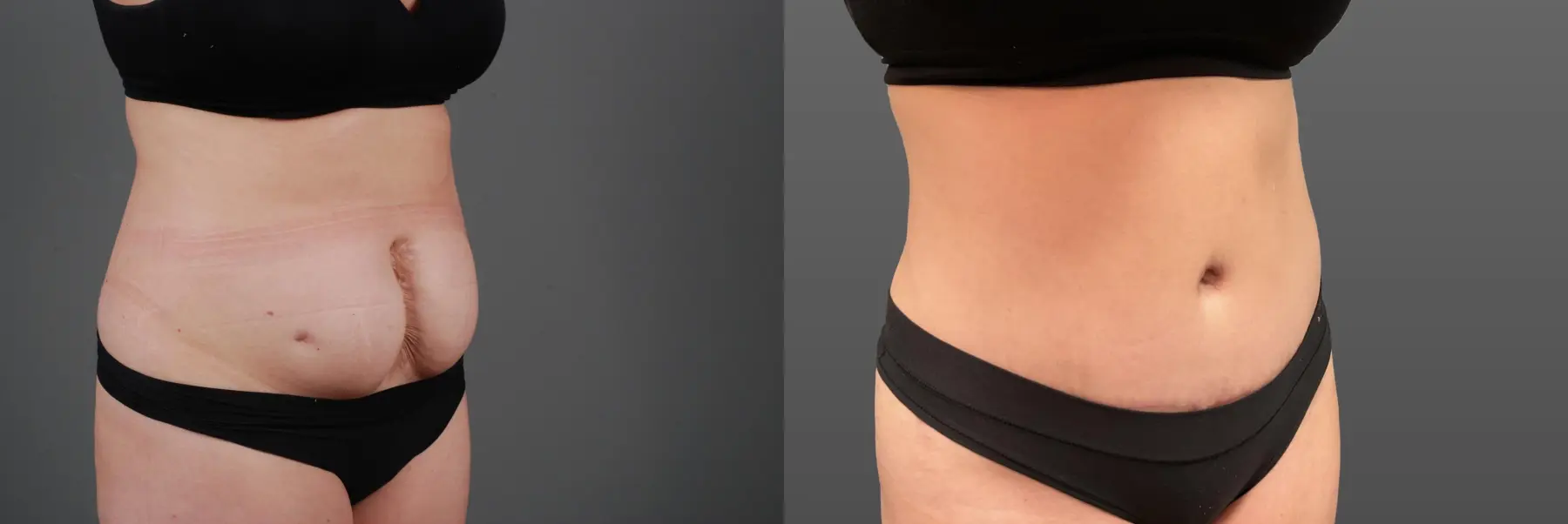 Abdominoplasty: Patient 11 - Before and After 3