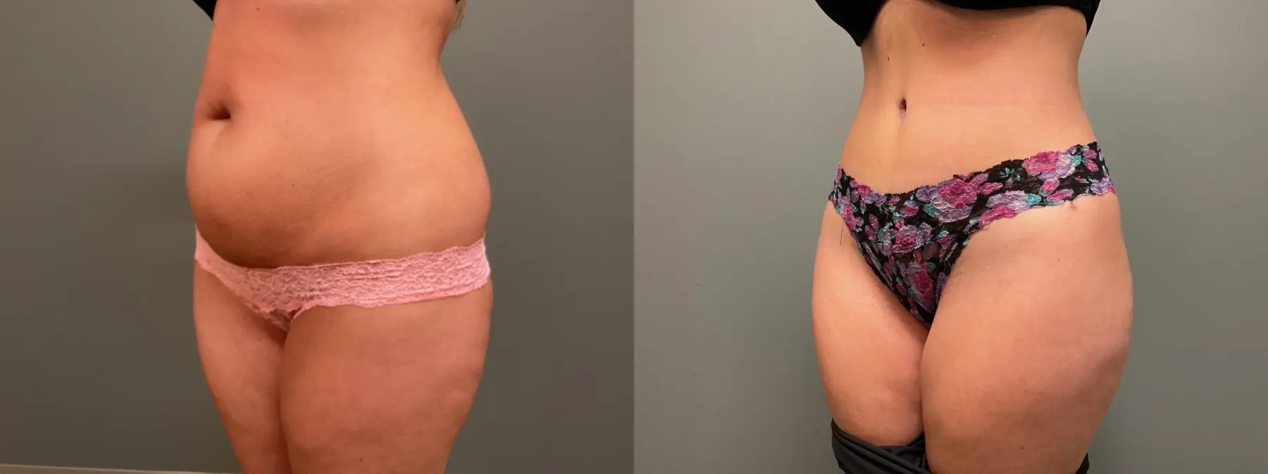 Abdominoplasty: Patient 13 - Before and After 2