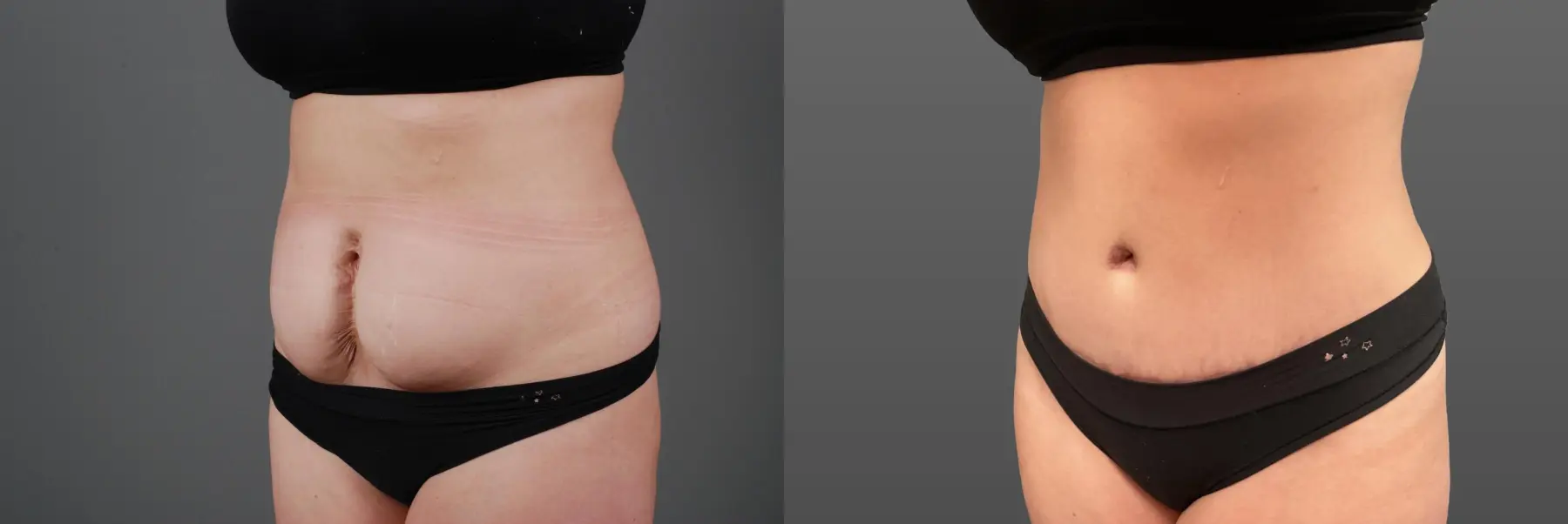 Abdominoplasty: Patient 11 - Before and After 5
