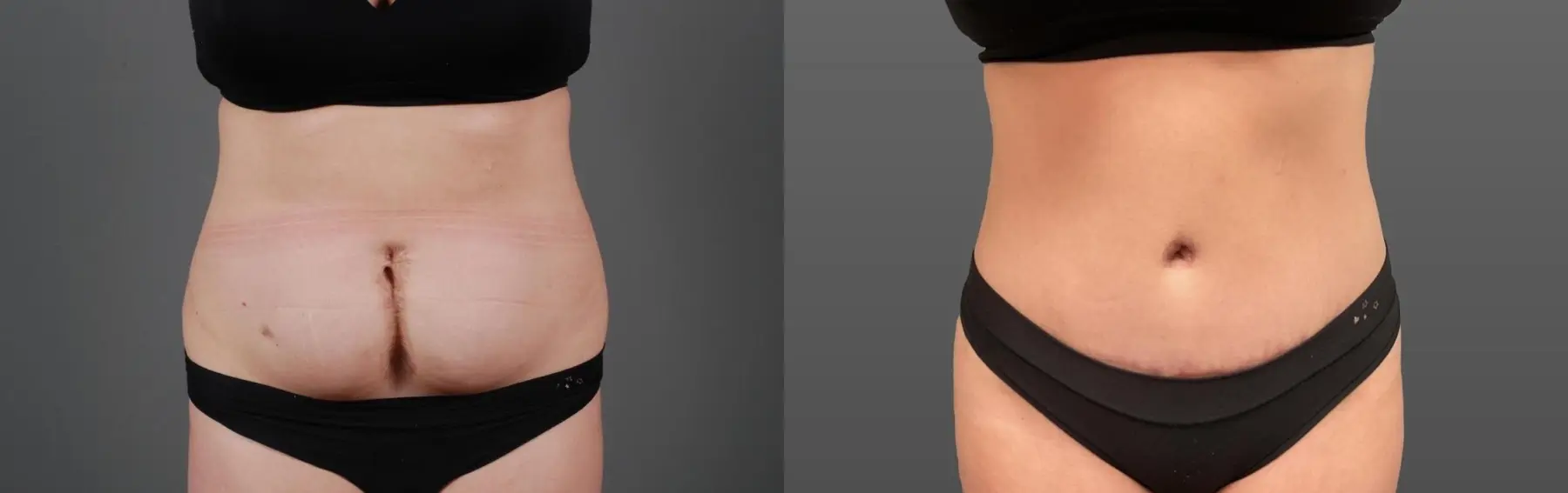 Abdominoplasty: Patient 11 - Before and After 1