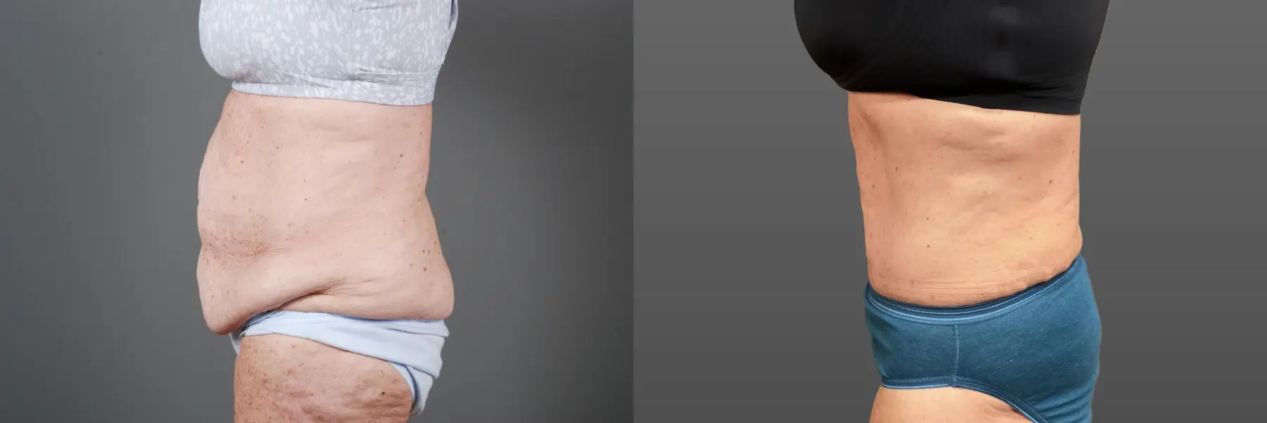 Abdominoplasty: Patient 12 - Before and After 4