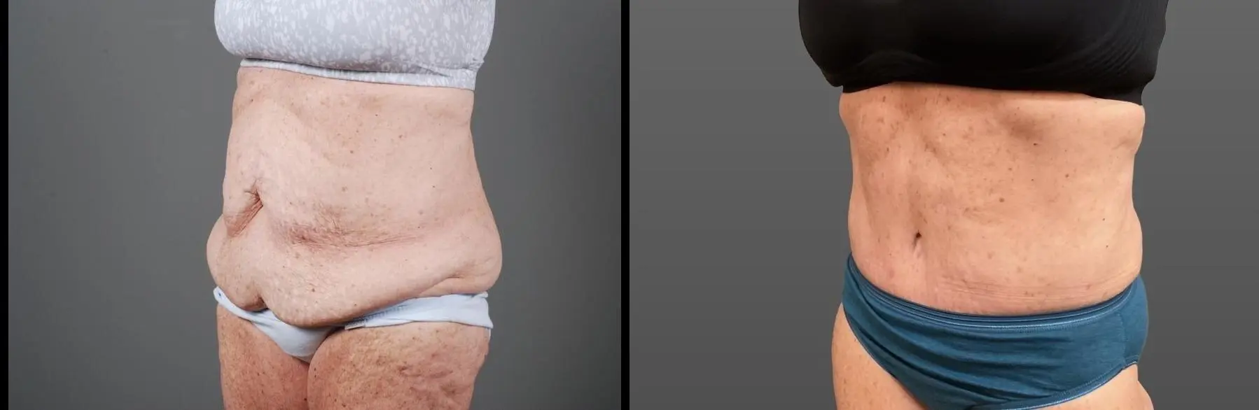 Abdominoplasty: Patient 12 - Before and After 3