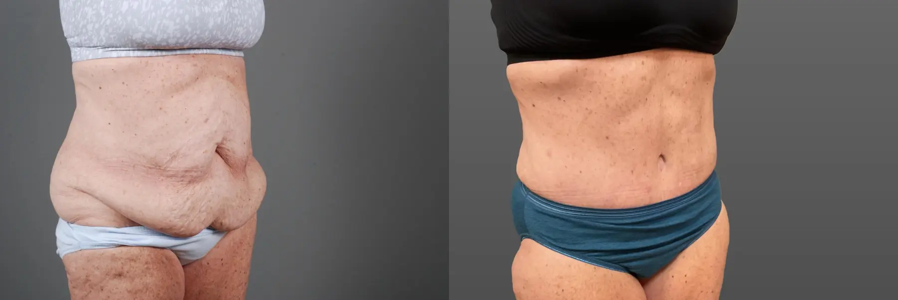 Abdominoplasty: Patient 12 - Before and After 5