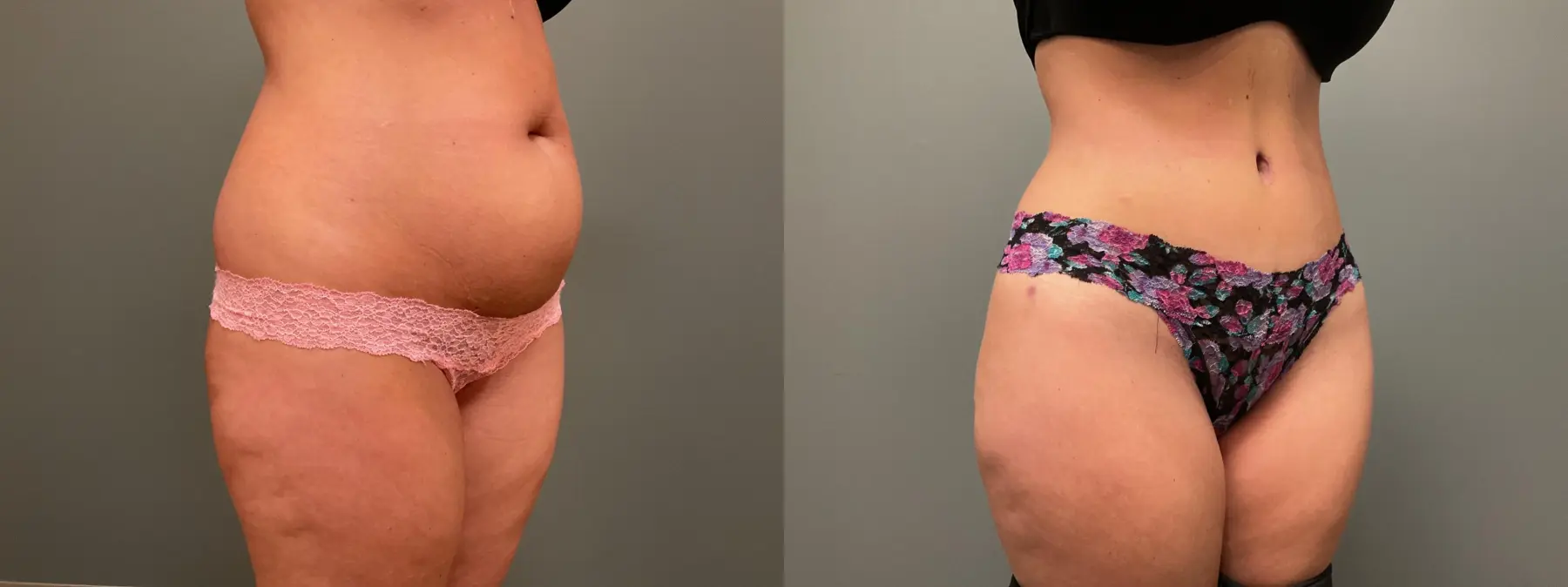 Abdominoplasty: Patient 13 - Before and After 3