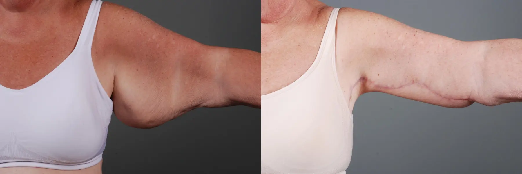 Arm Lift: Patient 1 - Before and After 3